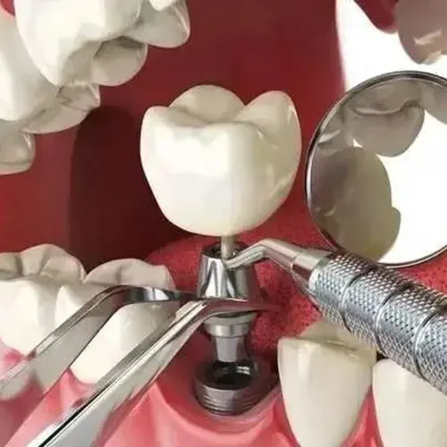 Os implantes de titânio são um dos meios mais eficazes de restaurar dentes lascados ou perdidos. Os materiais de implante mais comuns e populares utilizados na prática clínica são titânio puro e ligas de titânio.. Com o desenvolvimento da ciência dos materiais para implantes orais, os implantes podem ser amplamente categorizados em cinco tipos de acordo com seus materiais: materiais metálicos e de liga, materiais de carbono, materiais poliméricos, materiais cerâmicos e materiais compósitos.